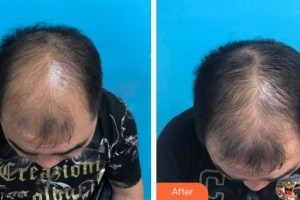 廈門(mén)銀河整形美容醫(yī)院呂巧云整形價(jià)格表附脫發(fā)調(diào)節(jié)重在堅(jiān)持案例展示