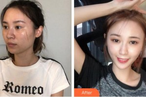 廈門(mén)新開(kāi)元醫(yī)院整形美容中心姜善潤(rùn)整形價(jià)格表附凹陷疤痕案例展示