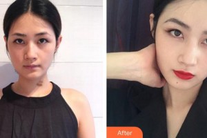 廈門(mén)新開(kāi)元醫(yī)院整形美容中心李城杓整形價(jià)格表附增生疤痕案例展示