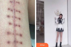 廈門(mén)新開(kāi)元醫(yī)院整形美容中心簡(jiǎn)銘成整形價(jià)格表附微創(chuàng)疤痕修復(fù)案例展示