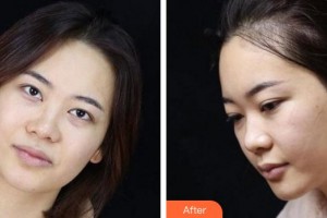 廈門(mén)海峽整形美容醫(yī)院曾美玲整形價(jià)格表附眼部整形案例展示