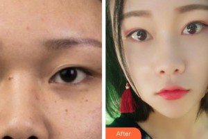 廈門(mén)海峽整形美容醫(yī)院劉歆整形價(jià)格表附眼部手術(shù)案例展示