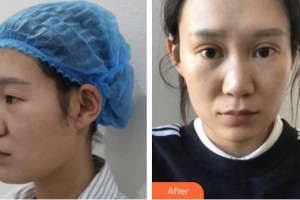 廈門(mén)大學(xué)附屬中山醫(yī)院整形美容科洪素莊整形價(jià)格表附雙眼皮案例展示