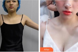 廈門(mén)大學(xué)附屬中山醫(yī)院整形美容科李鋒整形價(jià)格表附自體脂肪隆胸案例展示