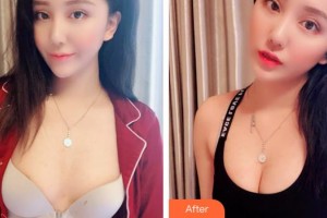 廈門(mén)福華醫(yī)療美容診所王建華整形價(jià)格表附濃縮豐胸真實(shí)案例展示