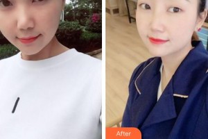 廈門(mén)修志夫整形美容醫(yī)院馮建苓整形價(jià)格表附肋軟骨隆鼻案例展示