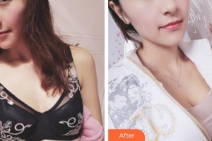 廈門(mén)天濟(jì)醫(yī)院醫(yī)療美容科朱文煌整形價(jià)格表附濃縮豐胸真實(shí)案例展示