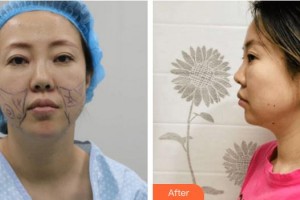 廈門(mén)黃巖整形美容醫(yī)院張皓林整形價(jià)格表附埋線提升案例展示