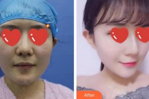 廈門(mén)美萊醫(yī)療美容醫(yī)院王忠堂整形價(jià)格表附	自體脂肪填充多方面部案例展示