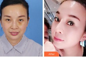廈門(mén)華美名媛整形美容醫(yī)院陳運(yùn)生整形價(jià)格表附埋線提升案例展示