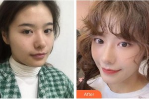 廈門(mén)美萊醫(yī)療美容醫(yī)院劉乃仁整形價(jià)格表附“熱瑪吉”多方面部 緊致提升案例展示