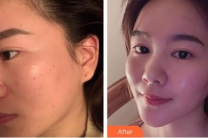 廈門(mén)華美名媛整形美容醫(yī)院翁秋霞整形價(jià)格表附激光美膚激光案例展示