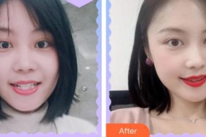 朱文碩整形價(jià)格表附牙齒隱形矯正案例展示