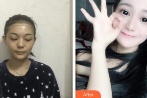 廈門(mén)華美名媛整形美容醫(yī)院陳燕喜整形價(jià)格表附種植發(fā)際線案例展示