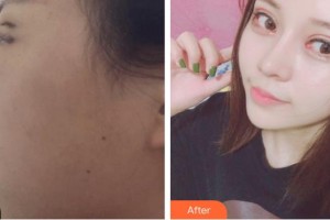 廈門(mén)薇格整形外科門(mén)診部俞翰秀整形價(jià)格表附雙眼皮案例展示