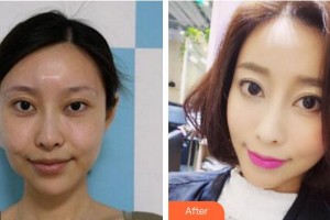 廈門(mén)薇格整形外科門(mén)診部尹惠蘭整形價(jià)格表附埋線提升案例展示