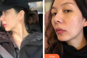 廈門(mén)安黛美整形外科門(mén)診部邱健欽整形價(jià)格表附熱瑪吉案例展示