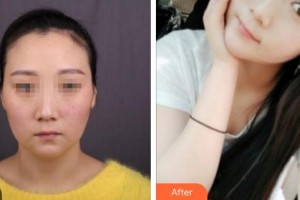 廈門黃巖整形美容醫(yī)院劉妍希住院醫(yī)師整形價格表附埋線提升案例展示