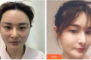 廈門黃巖整形美容醫(yī)院古恬音住院醫(yī)師整形價格表附埋線提升案例展示