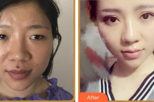 廈門修志夫整形美容醫(yī)院邰洪武整形價格表附眼部多項案例展示