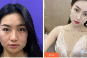 廈門華美名媛整形美容醫(yī)院于璇整形價格表附"熱瑪吉"年輕化緊致案例展示