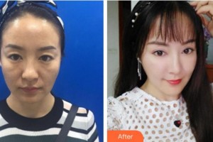 廈門華美名媛整形美容醫(yī)院陳秋珍整形價格表附埋線提升案例展示