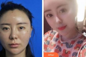 廈門華美名媛整形美容醫(yī)院姜靜整形價格表附抗衰年輕化熱瑪吉案例案例展示