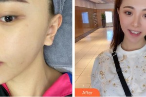 廈門臉博士整形醫(yī)院周虹整形價格表附祛斑案例展示