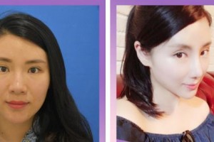 廈門美麗薇整形美容醫(yī)院吳原碩整形價格表附經(jīng)典美鼻部手術(shù) 多方位美鼻案例展示