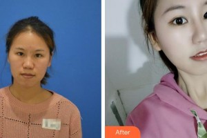 廈門美麗薇整形美容醫(yī)院樸晟皖整形價格表附鼻部手術(shù)案例展示