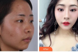 廈門美麗薇整形美容醫(yī)院金龍現(xiàn)整形價格表附耳軟骨隆鼻案例展示