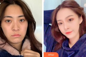 廈門(mén)蔡懿醫(yī)療美容診所謝樹(shù)榮整形價(jià)格表附埋線提升提升案例展示