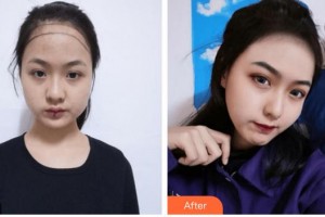 廈門(mén)碧蓮盛植發(fā)醫(yī)療美容門(mén)診部趙陽(yáng)整形價(jià)格表附美女發(fā)際線種植案例展示