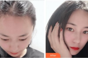 廈門(mén)碧蓮盛植發(fā)醫(yī)療美容門(mén)診部林威特整形價(jià)格表附發(fā)際線種植案例展示