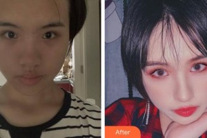 廈門(mén)顏施整形外科門(mén)診部林高萍整形價(jià)格表附面部埋線提升提升案例展示