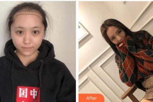 廈門(mén)重森植發(fā)整形外科門(mén)診部張斌奕整形價(jià)格表附發(fā)際線后移 女性發(fā)際線種植案例展示