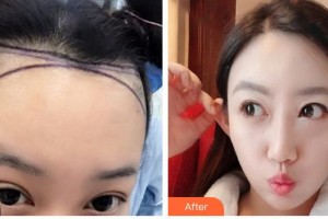 廈門(mén)重森植發(fā)整形外科門(mén)診部胡荔平整形價(jià)格表附發(fā)際線種植案例展示