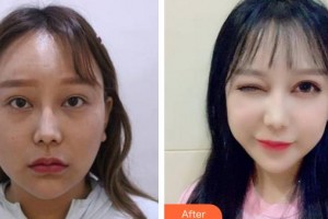 廈門(mén)市第三醫(yī)院眼科艾運(yùn)旗整形價(jià)格表附雙眼皮+眼瞼下至案例展示