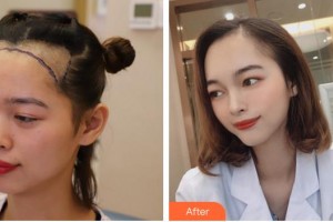 廈門(mén)重森植發(fā)整形外科門(mén)診部林先錦整形價(jià)格表附發(fā)際線種植案例展示