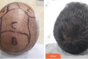 廈門(mén)雍禾植發(fā)醫(yī)療美容門(mén)診部王斌整形價(jià)格表附頭發(fā)種植案例展示