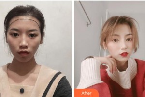 廈門(mén)雍禾植發(fā)醫(yī)療美容門(mén)診部鄧本文整形價(jià)格表附發(fā)際線高 發(fā)際線調(diào)整案例展示