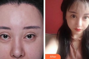 廈門(mén)大學(xué)附屬?gòu)B門(mén)眼科中心醫(yī)院蔡錦紅整形價(jià)格表附失敗重瞼修復(fù)+上瞼下垂矯正案例展示