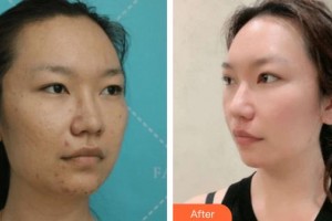 廈門(mén)大學(xué)附屬?gòu)B門(mén)眼科中心醫(yī)院盧奕整形價(jià)格表附雙眼皮案例展示