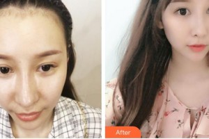 廈門(mén)雍禾植發(fā)醫(yī)療美容門(mén)診部潘朝林整形價(jià)格表附美人尖微創(chuàng)種植 發(fā)際線高案例展示