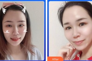 廈門(mén)大學(xué)附屬?gòu)B門(mén)眼科中心醫(yī)院劉旭陽(yáng)整形價(jià)格表附5S重瞼術(shù)+超微創(chuàng)開(kāi)內(nèi)眥案例展示