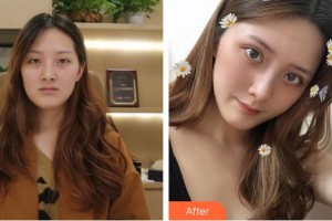 廈門(mén)大學(xué)附屬?gòu)B門(mén)眼科中心醫(yī)院王玉宏整形價(jià)格表附切開(kāi)雙眼皮案例展示