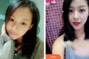 廈門(mén)大學(xué)附屬?gòu)B門(mén)眼科中心醫(yī)院陳偉整形價(jià)格表附精致雙眼皮案例展示