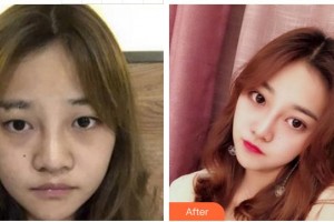 廈門(mén)大學(xué)附屬?gòu)B門(mén)眼科中心醫(yī)院吳仁毅整形價(jià)格表附眼部手術(shù)案例展示