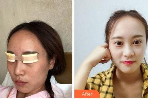 廈門(mén)大學(xué)附屬?gòu)B門(mén)眼科中心醫(yī)院劉志雄整形價(jià)格表附眼部手術(shù)案例展示