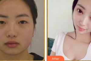 廈門(mén)大學(xué)附屬?gòu)B門(mén)眼科中心醫(yī)院毛祖紅整形價(jià)格表附眼部多項(xiàng)案例展示